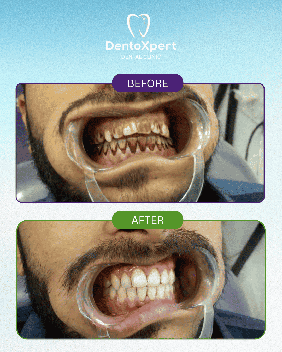 Before and after dental treatment result at DentoXpert Dental Clinic in Thane